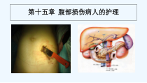 腹部损伤病人的护理-PPT课件
