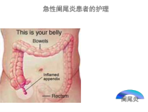 急性阑尾炎患者的护理详解课件