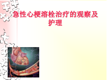急性心梗溶栓治疗观察及护理课件