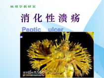 胃溃疡课件