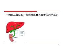 一例胆总管结石并发急性胆囊炎患者的药学监护课件