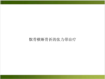 髌骨横断骨折的张力带治疗课件