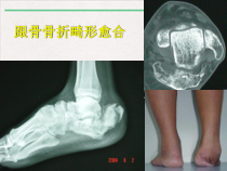 跟骨畸形愈合治疗公开课课件