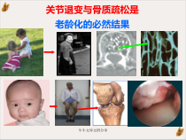 骨关节炎的阶梯治疗教材课件