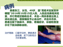 抗凝药物的不良反应与护理要点课件