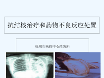 抗结核治疗和药物不良反应处置-课件