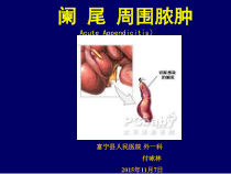 阑尾周围脓肿给药课件