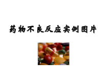 药物不良反应实例图片研究生课件