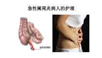 医学课件-急性阑尾炎病人的护理教学课件