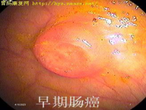 夜大结肠癌医疗护理课件