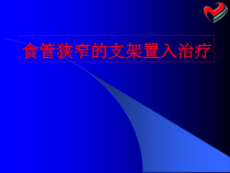 食管狭窄的支架置入治疗课件