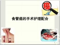 食管癌的手术护理配合医学课件