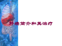 肝癌简介和其治疗培训课件
