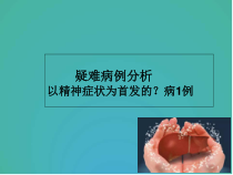 肝豆状核变性病例一例医学课件