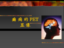 癫痫的PET显像课件