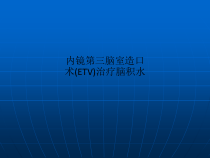 内镜三脑室造口术ETV治疗脑积水课件