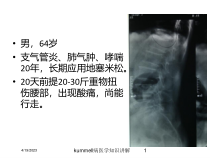 kummell病医学知识讲解课件