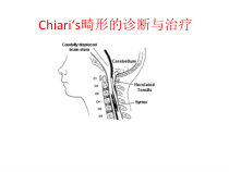 chiari畸形的诊断与治疗课件_2