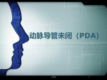 PDA动脉导管未闭专业医学课件