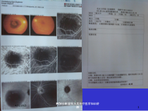 PCV诊断鉴别及其治疗医学知识讲解课件