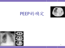PEEP的滴定医学课件