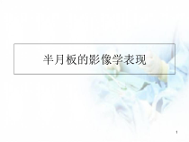 半月板的影像学表现医学课件