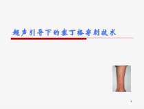 超声引导下的塞丁格穿刺技术医学课件