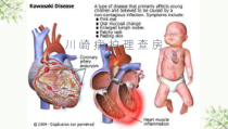 川崎病的护理查房医学课件