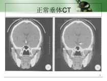 垂体影像学医学课件