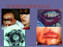 单纯疱疹病毒讲课医学课件