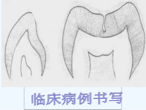 第四章龋病治疗课件