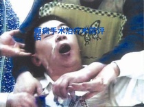 癫痫手术治疗术前评估课件