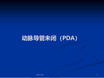 动脉导管未闭医学技术课件