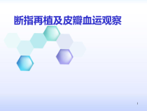 断指再植及血运观察医学课件