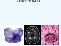 多发性硬化诊断与治疗课件