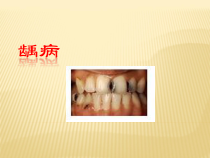 儿童龋病的治疗和预防课件