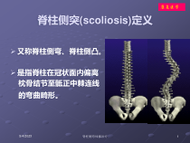 脊柱侧弯体操治疗培训课件