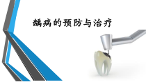 龋齿的治疗课件