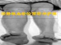 深静脉血栓的预防与护理医学课件