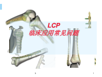 锁定内固定系统临床应用常见问题医学课件