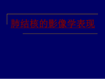 医学肺结核的影像学表现培训课件