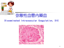 医学课件-DIC的诊断及治疗课件