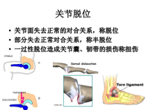 医学课件-关节脱位教学课件