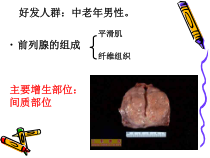前列腺增生的护理课件