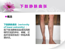 下肢静脉曲张的护理查房课件