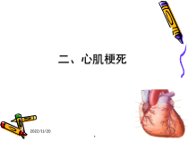 心肌梗死的护理课件PPT课件