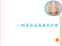 一例鼻出血患者的护理-共24页课件